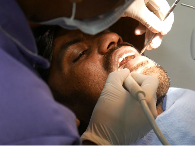 Fluoride Treatments